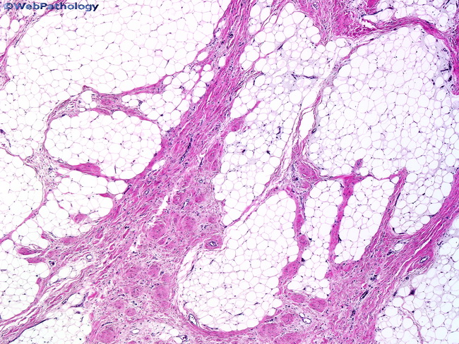 Soft Tissue_Lipomatous_Lipoblastoma1.jpg